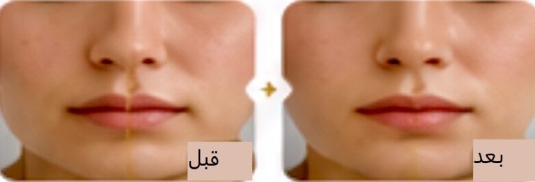 متدهای جدید فیلر لب
